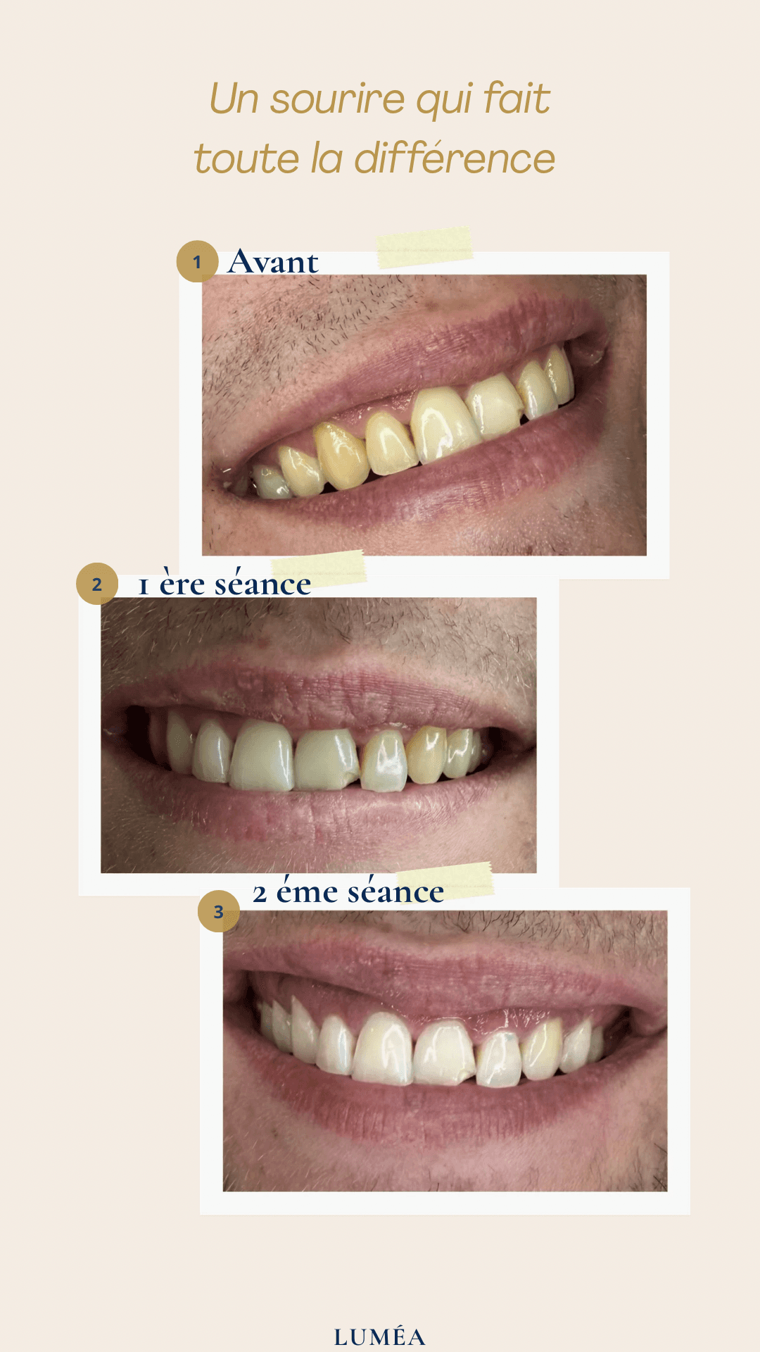 Évolution d'un sourire avant, après une première puis une seconde séance